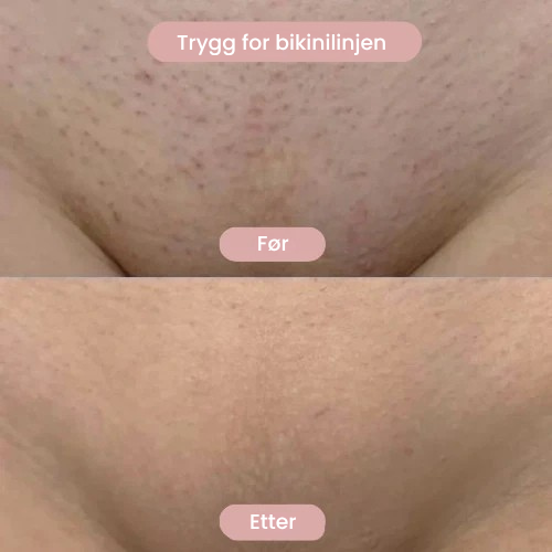 SilkySkin – Intimbarbering uten irritasjon